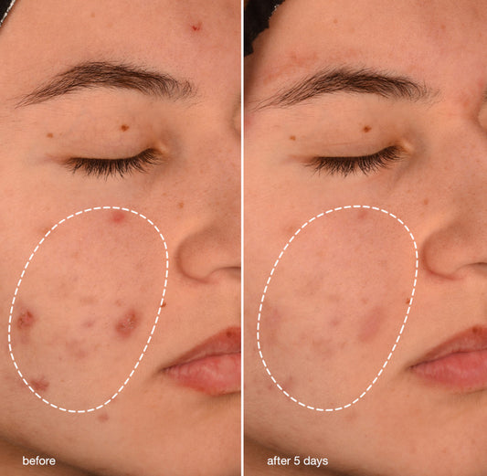 Breakout Biotic Moisturizer